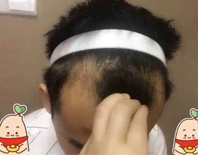 我之前前额鬓角脱发较严重,是m型脱发.