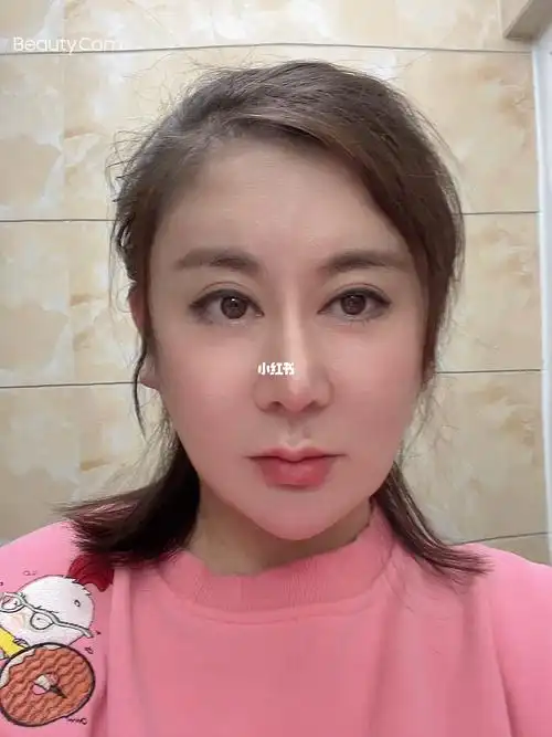 拉皮术后第七天一天比一天好开心