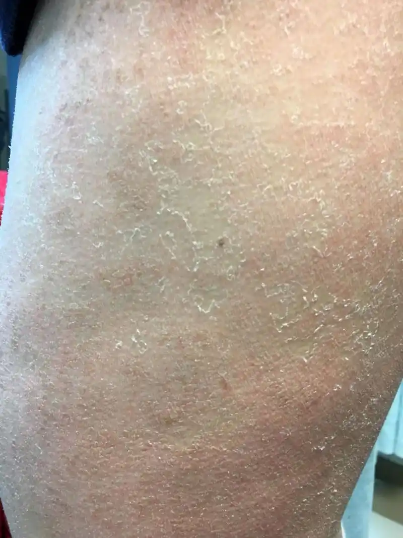 就是年轻人,30岁左右的人也会有皮肤干燥脱皮,伴有瘙痒