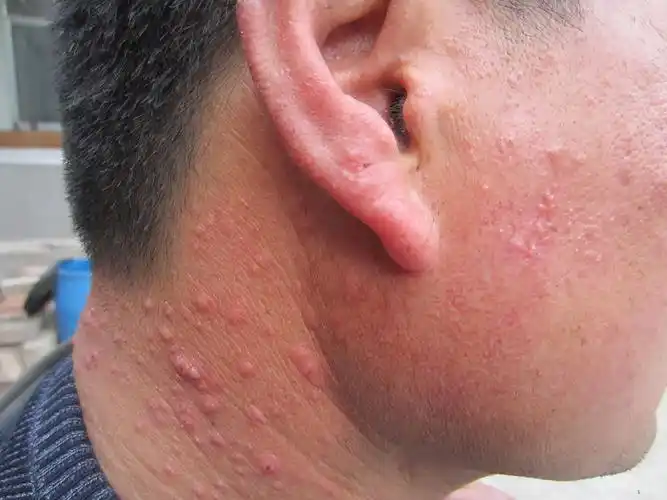 多形性日光疹 - 皮肤及性传播疾病讨论版 - 爱爱医医学论坛