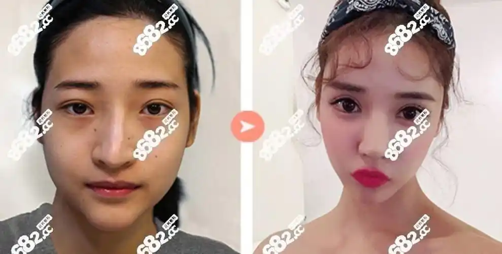 韩国珠儿丽切开法双眼皮修复前后对比图