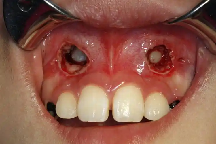 虎牙阻生的牵引 - 好大夫在线