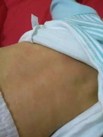 老公说说蛋白质过敏,晚上吃母乳,第二天就基本上不怎麼红了,请问这是