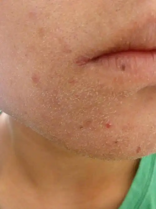 皮肤性病科 皮肤科 → 脸部脱皮严重,是什么原因呢?