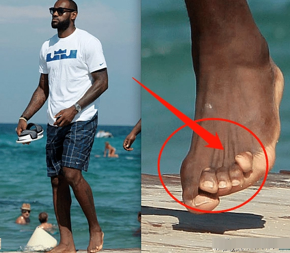 nba巨星训练有多苦请看看詹姆斯杜兰特和奥尼尔的脚趾