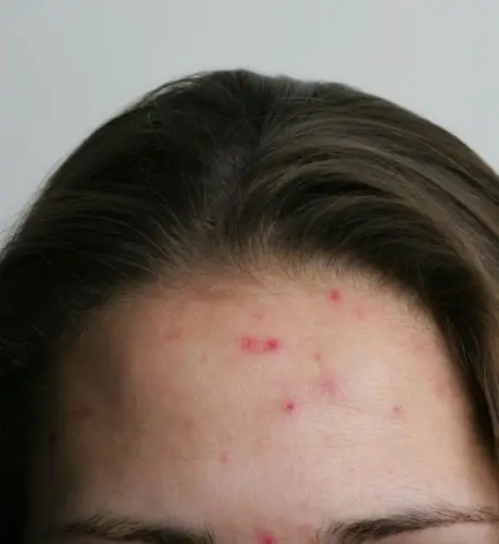 美肌教主:暗疮印属比较容易解决的皮肤问题