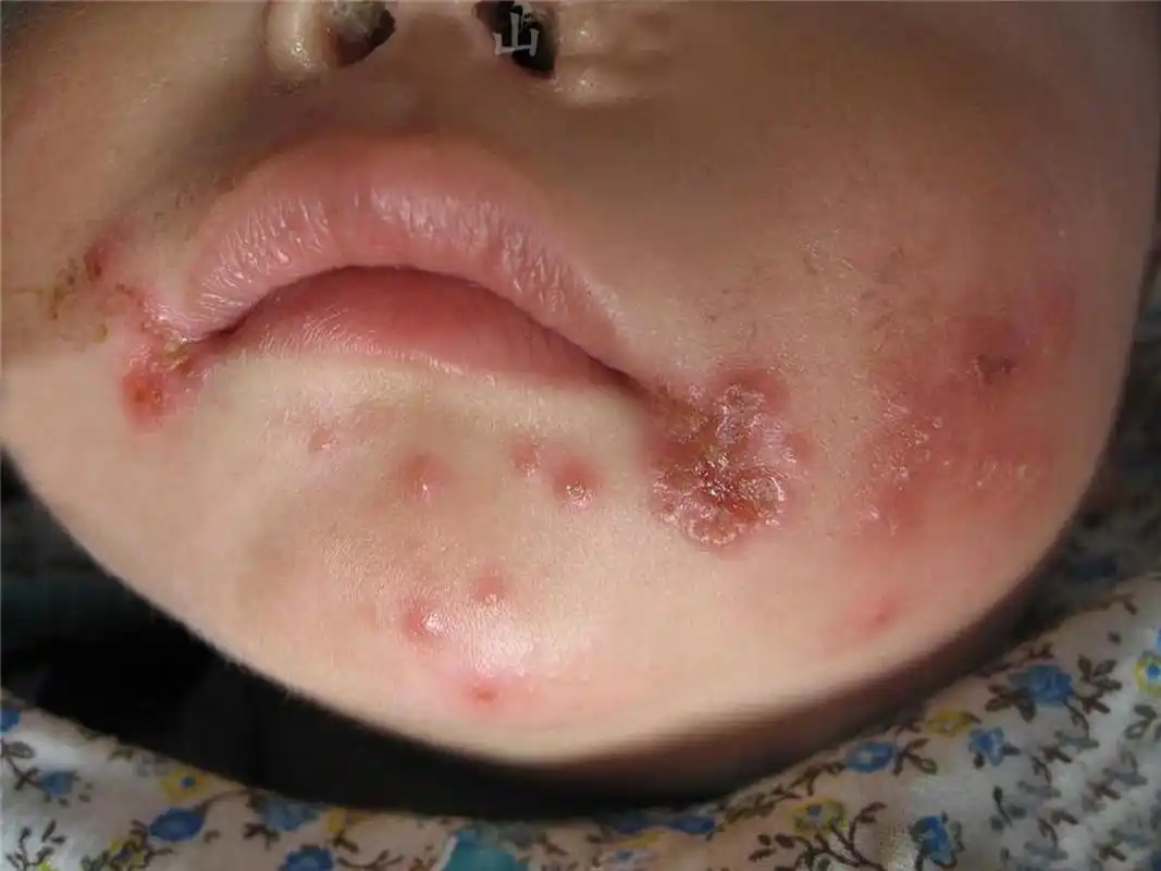 单孔荣主任分享改善单纯疱疹的方法 你是不是经常在嘴巴周围长一簇簇