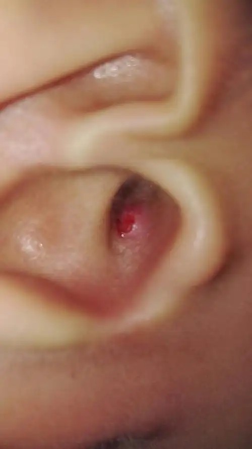 耳朵里长了个包,稍微按一下就疼的很,刚开始只是痒,后来长出来的,开始