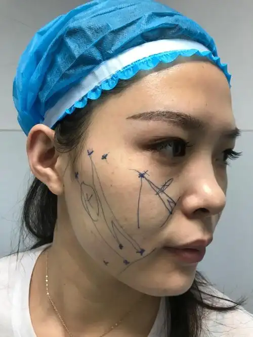 中面部线雕解决初老问题,年轻逆袭回饱满感