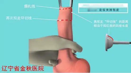 金秋健康科普关注生殖健康带您了解一次性包皮环切吻合器手术