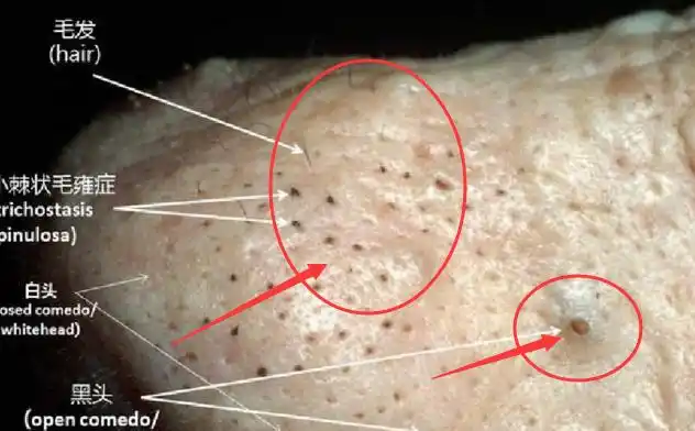 鼻翼上饱满的黑头粉刺,常用卫生间乳白色的"它",洗去黑头净化毛孔