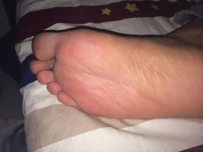 脚掌前面这块皮硬硬的. 但不痒 有几个红红的点 脚丫出有轻微脱皮