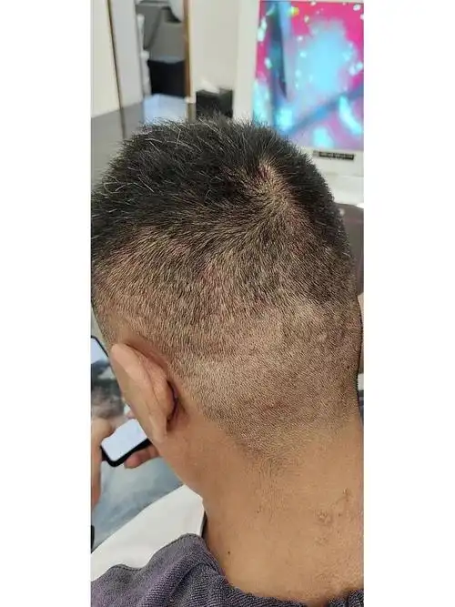 头皮毛囊炎头皮屑脂溢性脱发