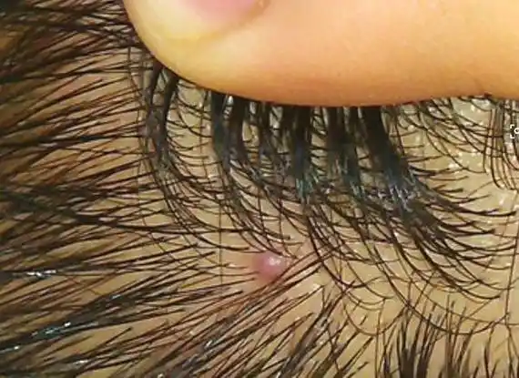 头皮很痒,有小红点,别拿头皮毛囊炎不当回事!