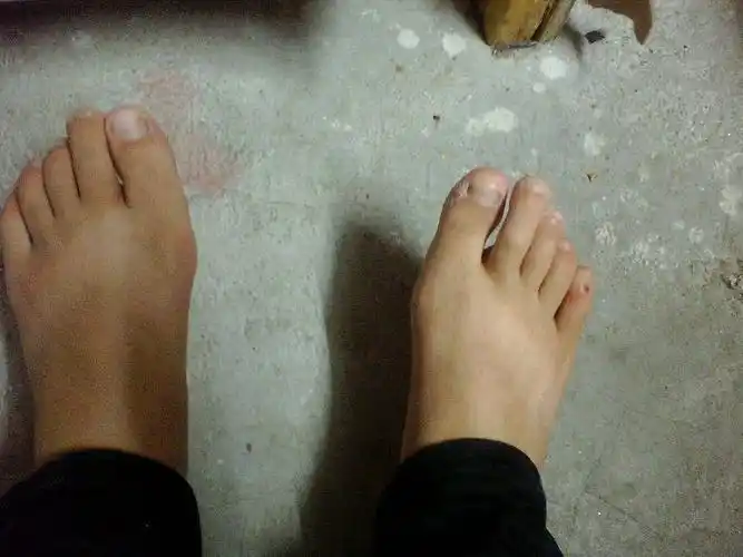 我的脚大脚趾部分很大,很突出,很丑,穿什么鞋都丑,能通过什么