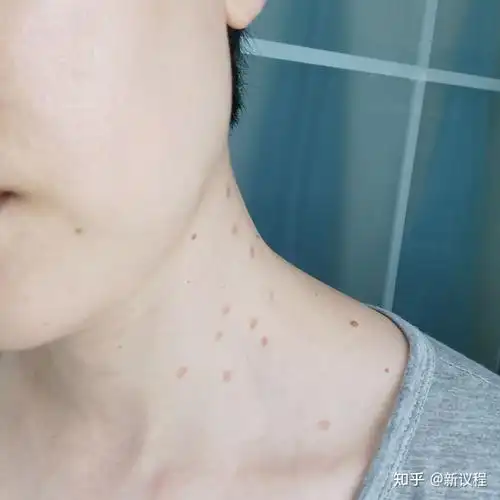 产后脖子丝状疣处理记录