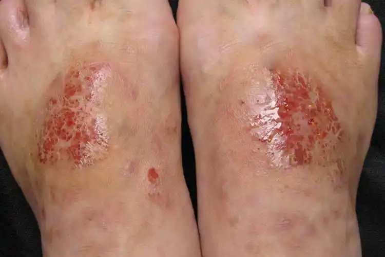 1干燥型干燥型从字面上看就是指湿疹在婴儿皮肤表面只会是红色小班或