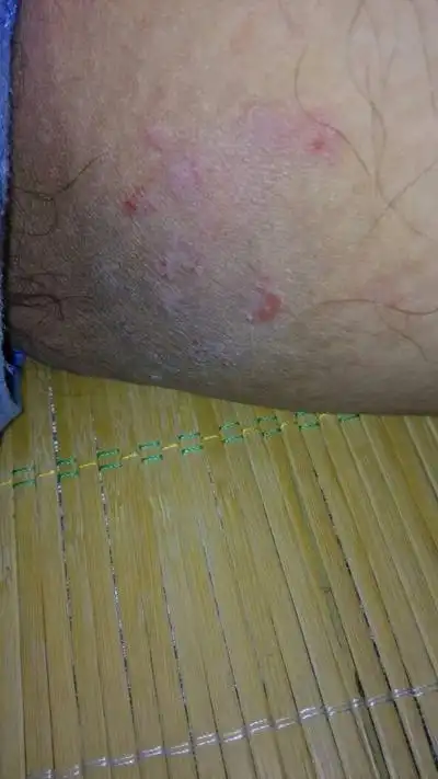 股廯的症状图片 (9)