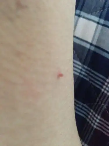 腋下长了一个凸出来的小东西,这是什么?能拿剪刀剪了吗?