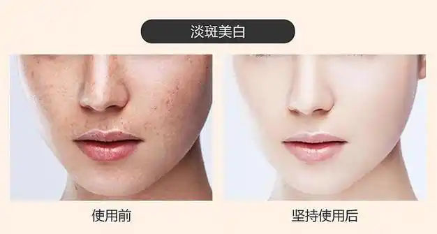 祛斑效果最好的排名第一,排行榜前五名,斑点肌值得拥有|美白|肤色