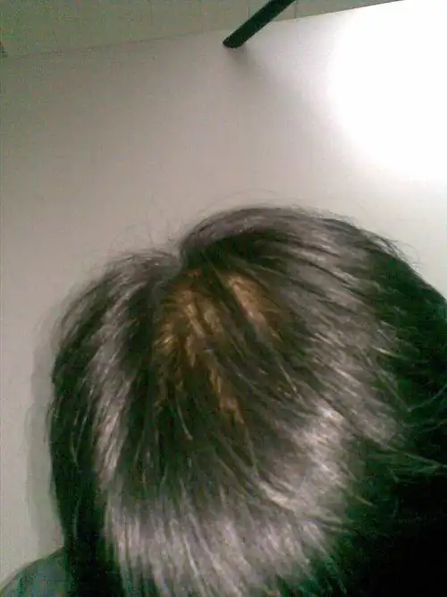 我谢顶算厉害吗?20岁,有图片