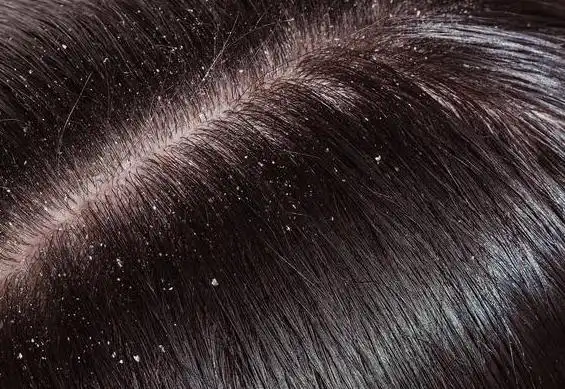 干性发质刚洗完头发还是有头屑1招简单教你去除头屑