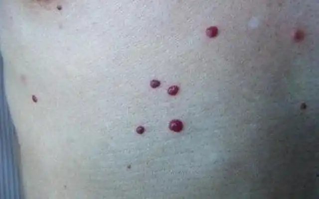 而血痣是所有"血泡"种类中最常见的一种,血痣因肤表或粘膜局部毛细