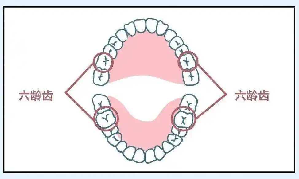 特别是上排牙齿难清洁,最容易导致龋齿.