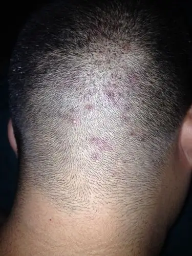 后脑勺一大块长疮有一些里面还有白色的浓不疼不痒长好几年