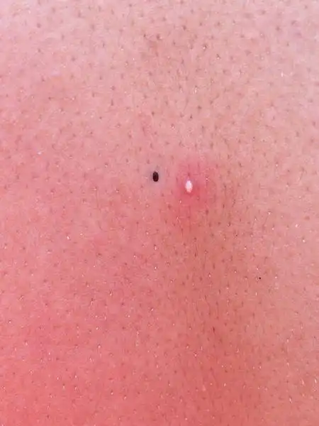 这是在我背上的一个小黑点 它不是痣朋友说好像是一种虫这到底是什么?