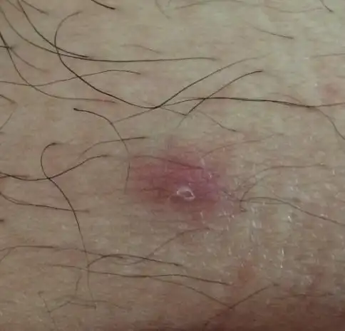 皮肤性病科 性病科 梅毒 → 这个是硬下疳吗?长出来有一周了,刚开始触