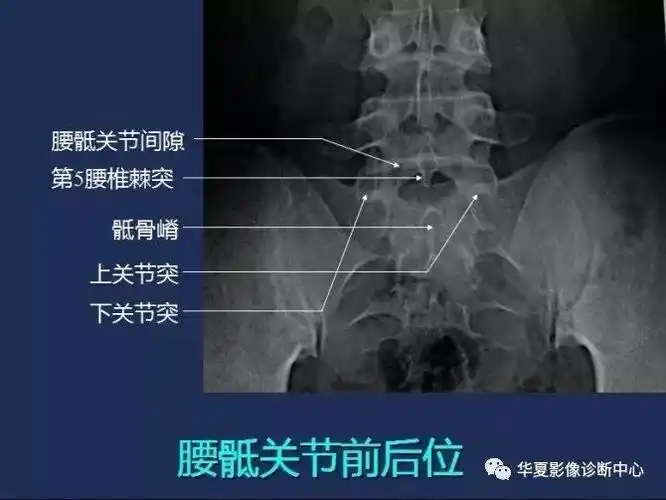 x线解剖图谱腰骶关节
