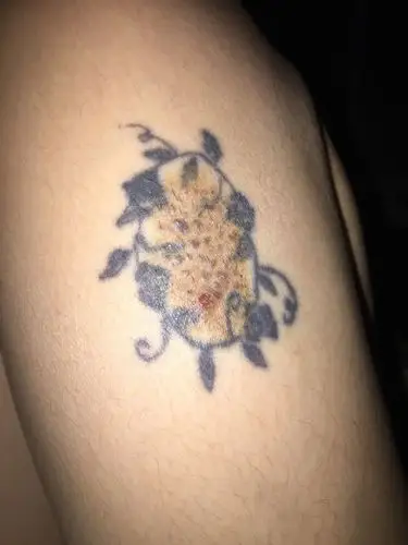 这个是什么胎记呢?在大腿上的,外面一圈花