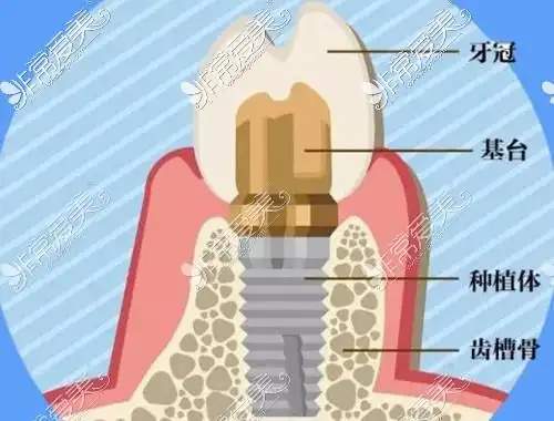 种植牙二期上基台步骤和过程有哪些来看详细种植牙二期