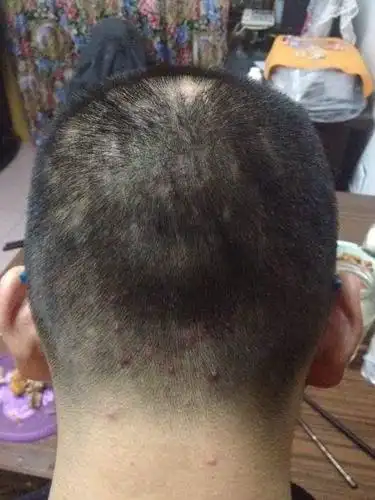 毛囊炎的症状有哪些?