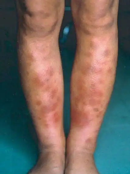 脂膜炎已影响正常生活,该如何治疗?