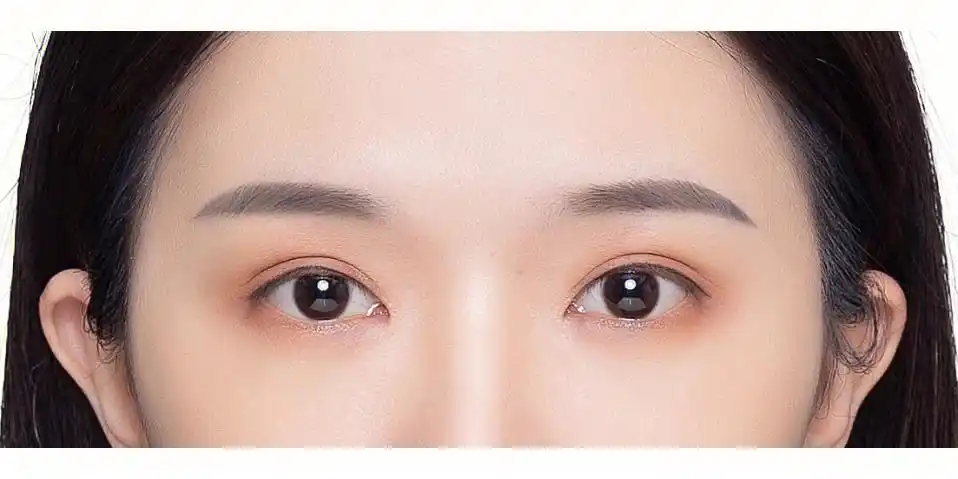 全切双眼皮半年对比