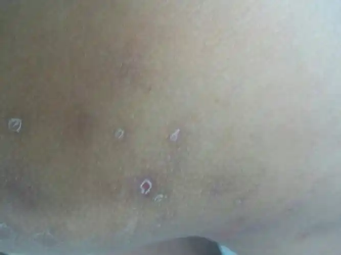 皮肤病还是什么?