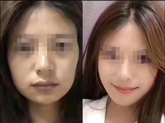 面部脂肪填充术前术后对比 - 好大夫在线