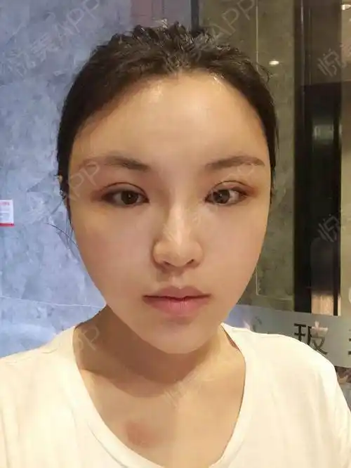 自体脂肪填泪沟术后15天_吸脂瘦大腿术后15天_自体脂肪面部填充术后15