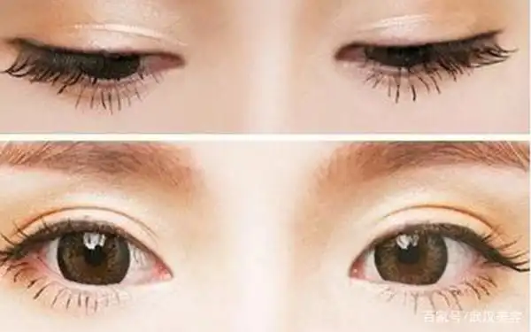 眼部填充脂肪怎么样