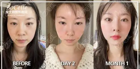 做prp全脸自体脂肪填充及1个月恢复照