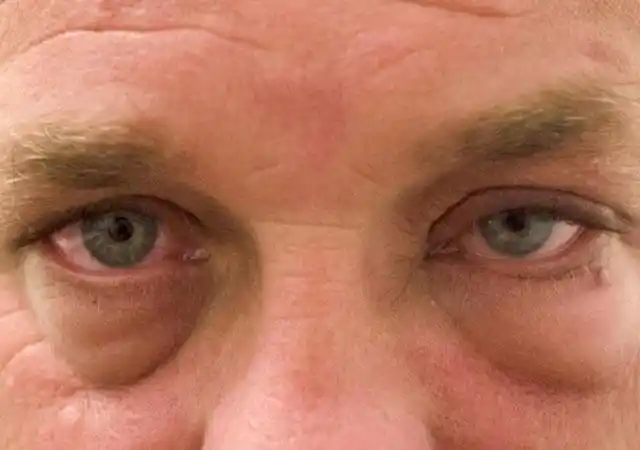 肾病眼皮肿图片肾不好眼睛浮肿的图片