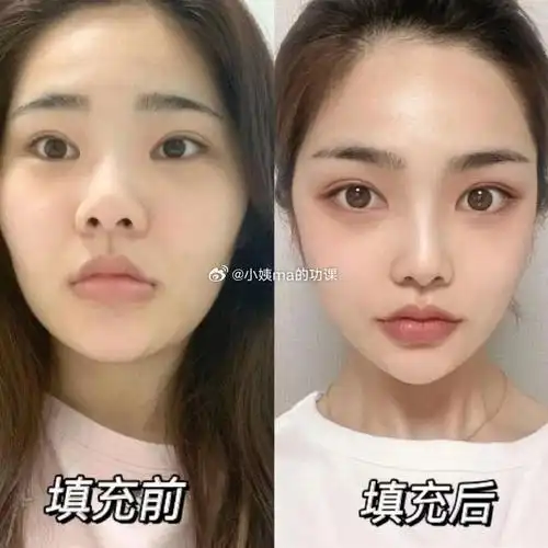 北京自体脂肪填充##上海全脸填充