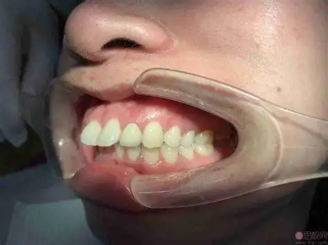 龅牙牙齿矫正的费用不是一成不变的,普通的成人金属矫正费用在5800元