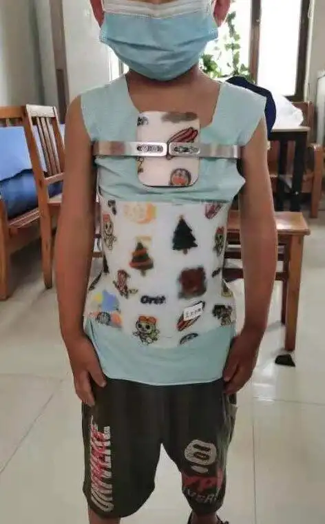 部分保守治疗以后效果不佳的鸡胸患者呢,还可以通过微创的方法进行