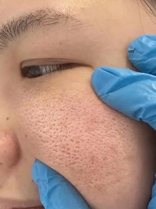 毛孔粗大一直是许多人最困扰的皮肤问题之一.