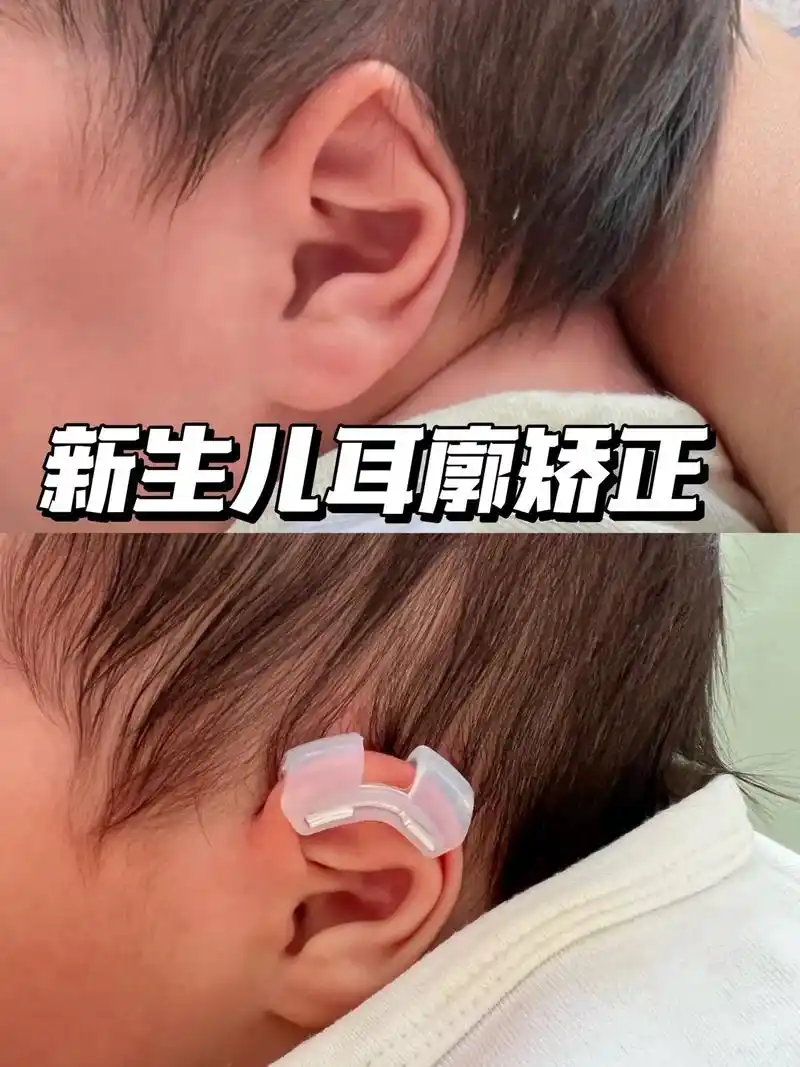 新生儿耳廓畸形矫正
