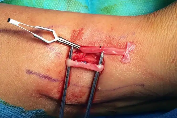 这样的端侧吻合似乎更加顺畅