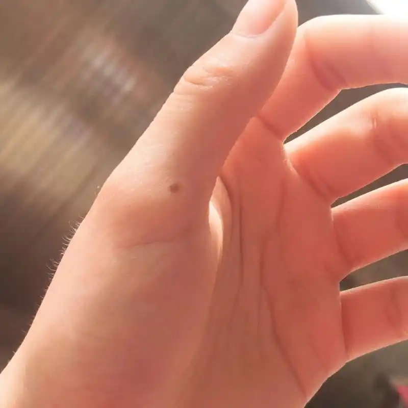 左手大拇指长痣 左手大拇指长痣,小时候长的,越长越大颜色越浅.